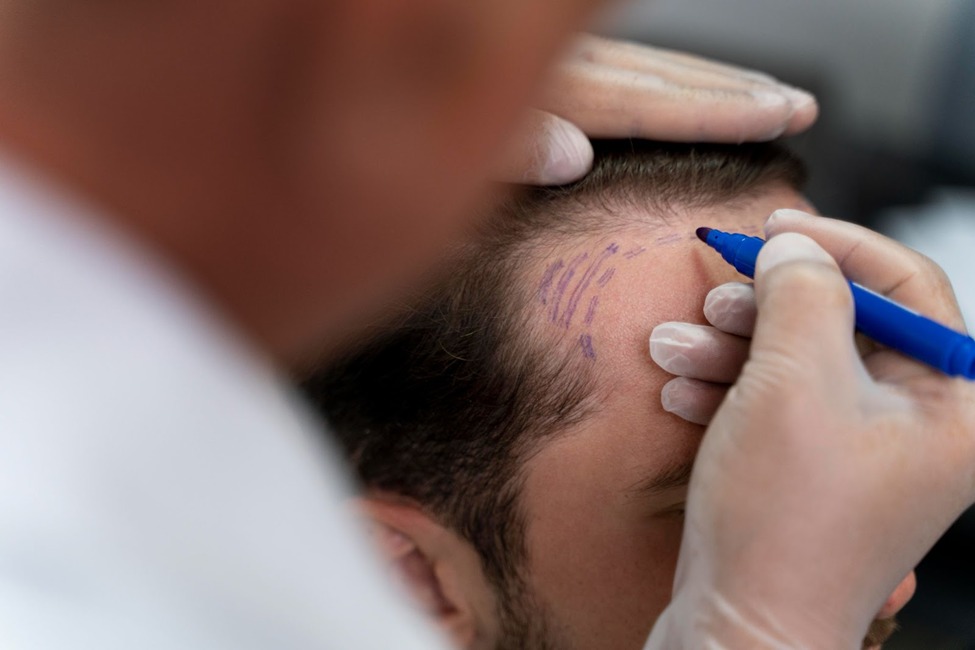 hair transplant